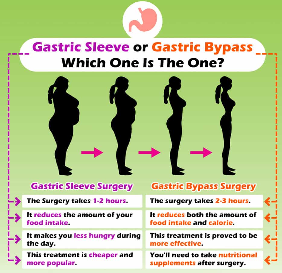 gastric bypass or gastric sleeve